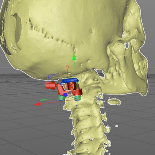 3D printed implant for the medica industry